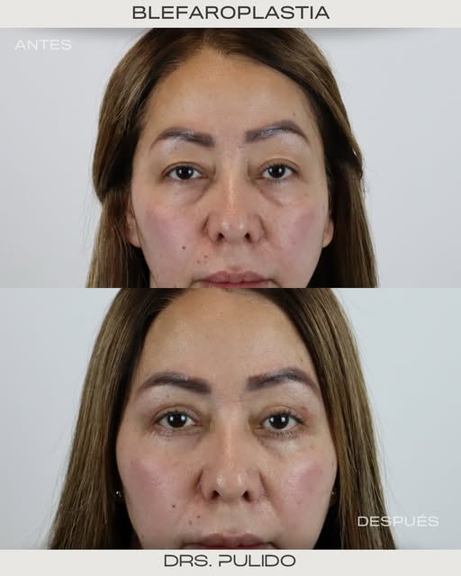 Una mirada más fresca, natural y rejuvenecida. ✨
Blefaroplastia completa: armonía y definición alred