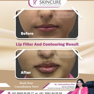 ✨ Confidence, redefined.

💋 Witness the magic of Lip Filler & Contouring at Dr. Chitra’s Skincure —