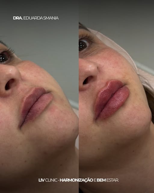 Um resultado que não precisa ser exagerado para fazer diferença. 👄

Mais contorno, proporção e defi