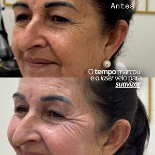 O tempo deixa marcas, mas a pele também pode ser estimulada a se renovar. ✨

Esse antes e depois mos