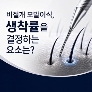 모발이식, 많이 심는 것보다 얼마나 잘 생착하느냐가 더 중요합니다. 🌱

비절개 모발이식의 결과는 모낭 채취부터 보관, 이식 기술, 수술 후 관리까지 여러 요소가 함께 결정합니다
