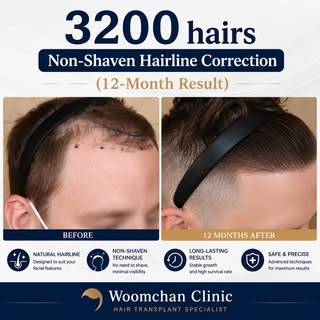 Hello! Welcome to Woomchan Hair Clinic! 😊

Today, we’re sharing the 12-month progress of a 3200-gra