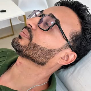 Micropigmentação para harmonização na Barba. Método Natural+. 
Sempre trazendo resultados naturais e