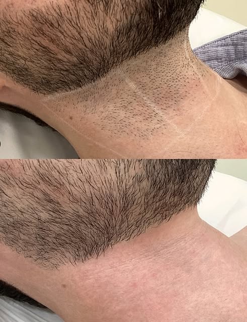 Épilation laser chez l’homme ⚡️

De nombreuses zones du corps peuvent être traitées au laser. Chez l