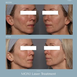This result was achieved after a single session performed by Amanda Walczak, RN, BSN, our Aesthetics