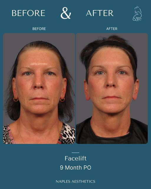 This patient chose Dr. Kent Hasen for her facelift.
Her procedure was planned around her facial stru