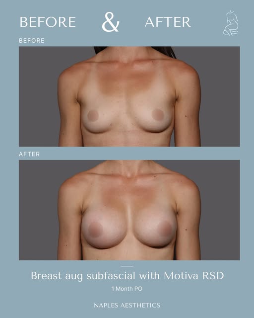 Breast augmentation with Dr Hasen, shown at seven months. This patient started with one breast notic