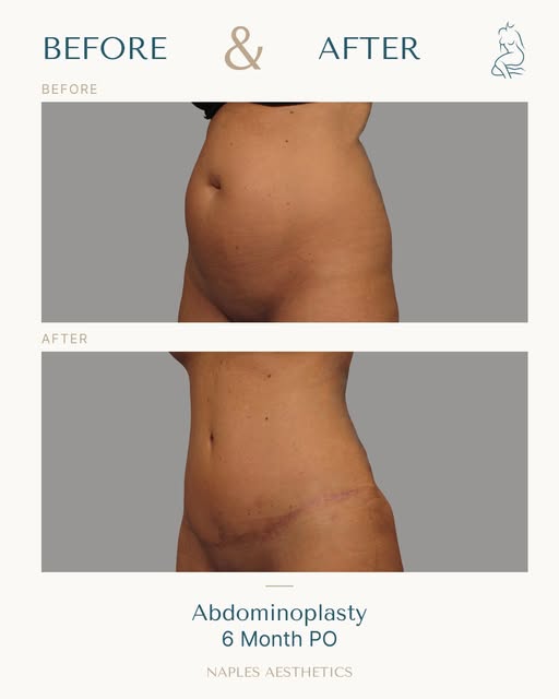 This is what healing looks like six months after abdominoplasty, performed by Dr. Hasen.
While recov