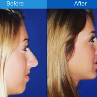 Before/After rhinoplasty and chin augmentation #cosmeticare #adairmd #plasticsurgery #cosmeticsurger