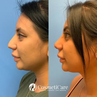 Before and After: Rhinoplasty 👃🏼
•
•
Visit CosmetiCare.com to learn how you can receive $1,000 off