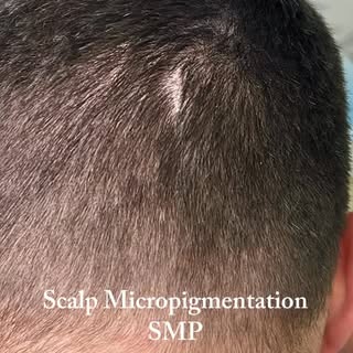 Some scars tell a story… but they don’t have to define how you feel about your hair.

Scalp Micropig