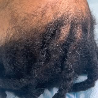 Women’s SMP Hairline Transformation ✨

This is only the FIRST session and you can already see the di