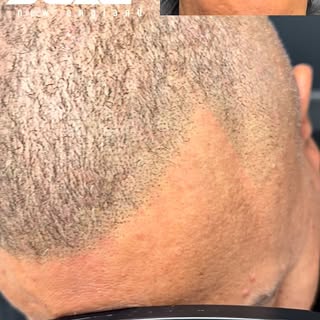 Nice new hairline for this client. Book your free consult at Scalp New England #hairtattoo #bostonsm