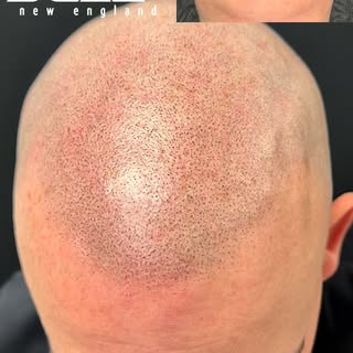 From completely bald, to looking like he has a full head of hair. If you’re looking for completely u