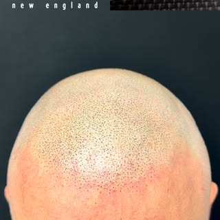 Scalp New England | 13+ years of trusted care, proven results, helping clients across New England re