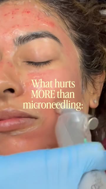 Microneedling? Numbing cream, a little tingle, and glowing skin after. 

Way easier than any of the 