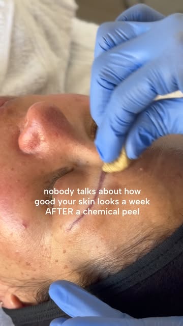 A few days of peeling, then a week later your skin looks brighter, smoother, and more even 🙌 

That