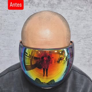 ¿No te sientes cómodo con la alopecia? 🙃

Es momento de retomar el control 😎. Hoy en día, la tecno