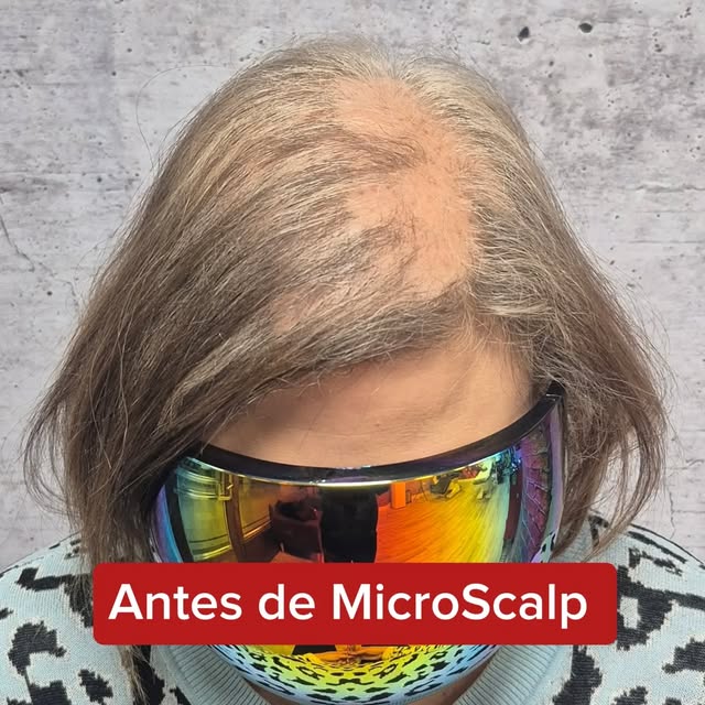 ¡El cambio que estabas buscando es posible, sin importar la gravedad del caso! 💖✨

La alopecia feme