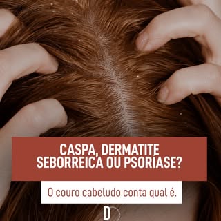 Descamação, coceira, vermelhidão e oleosidade podem parecer sinais de um mesmo problema, mas diferen