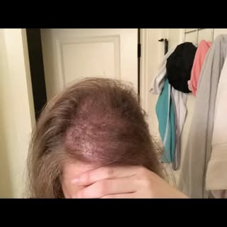 Every time a client regrows their hair and  gets their confidence back, it truly is a win 🏆 for us!