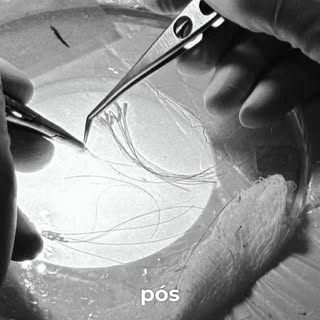 Sua autoestima de volta com um olhar natural e definitivo. ✨

Apenas 8 dias de pós-operatório e o re