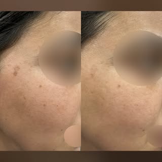 ☀️ Sun spots & freckles stealing your skin’s glow?

Laser treatment for pigmentation can help target