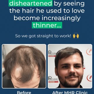 Meet Dan 🌟 

When he first came to MHR Clinic, he was disheartened watching the hair he once loved 