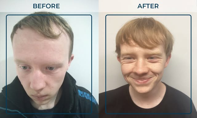 “THE RESULTS ARE BETTER THAN I IMAGINED.” 👏

What a transformation for Aaron.

When Aaron first cam