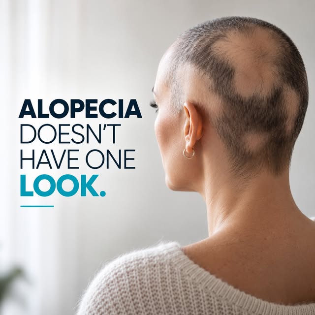 ALOPECIA DOESN’T HAVE ONE LOOK. 💙

As Alopecia Awareness Month continues, broadcaster Melanie Sykes
