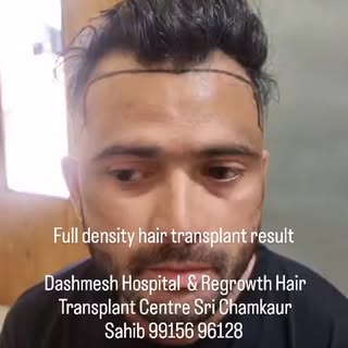 💯 % Guaranted #hairtransplant results @folowers