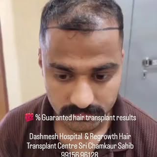 Full density hair transplant #DHI #hair #hairstylist #nature follower