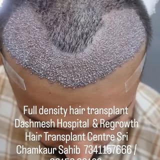 #hair transplant 
DM for any queries and consultation 7341157666 / 99156 96128