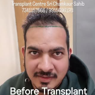 #hairtransplant result after 8 months
DM for any queries and consultation 
7341157666 / 9915696128