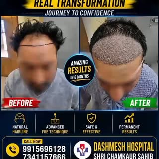 #hairstylist #hair #hairtransplant #nature #hairtransformation