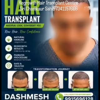 #besthairtransplant Bald to natural hair #fue