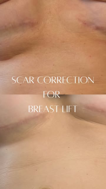 Scar CORRECTED after TWO Scar Camouflage sessions! 🤍

This breast lift scar correction is about sof