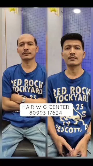 Mirage hair patch | scalp base hair patch | skin colour hair wig | guwahati,  Near Railway station, 