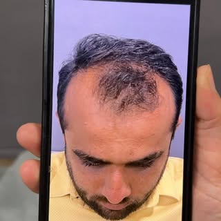 “New hair, new confidence! Say goodbye to hair loss and hello to a fuller you. Book your transformat