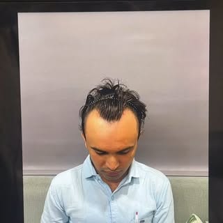 From hair loss to hair boss 💇‍♂️✨
Your confidence deserves a comeback!
Swipe to see the transformat