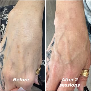 ☀️ SUN SPOTS. 2 SESSIONS. REAL RESULTS.

Same client. Same hands. And only 2 Laser Pigmentation Remo