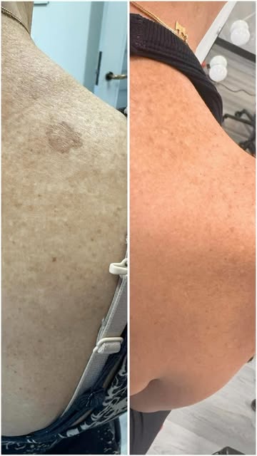 2 sessions. 1 very satisfying before & after. 

This is Laser Pigment & Lesion Removal - a targeted 