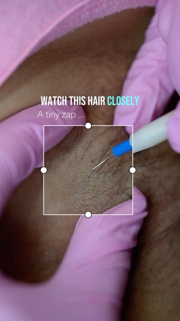 ✨ The only FDA-approved permanent hair removal treatment ✨

Tired of endless shaving, waxing, or las
