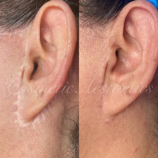 Facelift scar camouflage 🙌🏼⁣
⁣
⁣
⁣
#scarcamouflage #scarcamouflagetattoo #scarcamo #scarcoveruptat