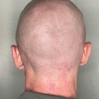 Love a good transformation! Check out this healed Scalp Micropigmentation ⁣
⁣
⁣
⁣
⁣
⁣
#scalpmicropig