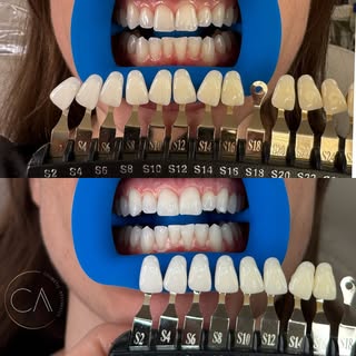 Incredible teeth whitening results! 
We use an organic product, it takes 1 hour and lasts up to six 