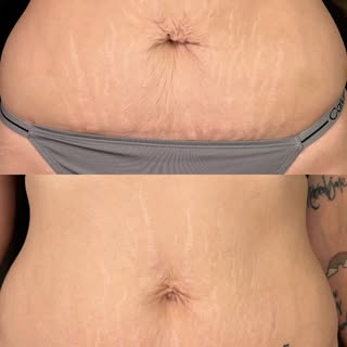 Loose skin? No problem! We’ve got you 🙌🏼 Microchanneling never fails to amaze me! This is after ju