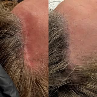 Another forehead scar camouflage for the win 🙌🏼 
1-833-tattoo-u

#foreheadscar #scarcamouflage #sc