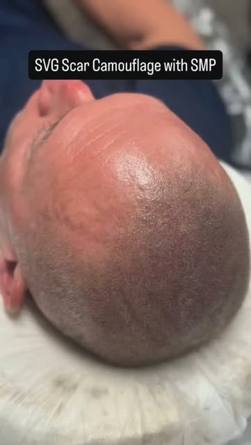 Your scars don’t have to stand out — and your hair doesn’t have to look thin. 👀

Scalp Micropigment