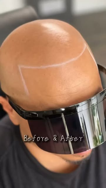 A hairline so seamless, nobody has to know. 🔥

SMP creates the look of natural, freshly shaved foll